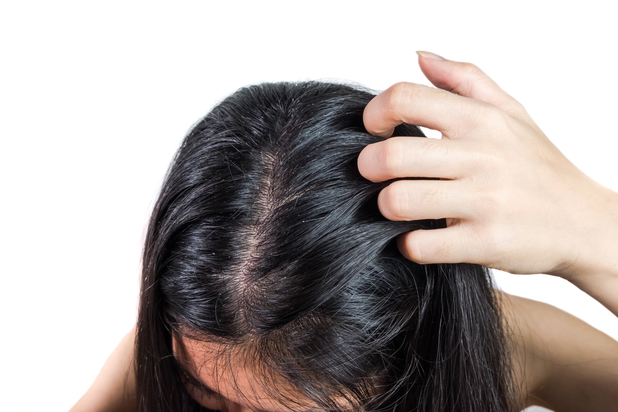 9 Natural Remedies for Dandruff That Actually Work - Ethan Thomas Collection